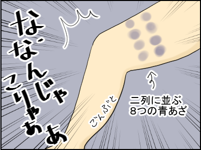 青あざ2
