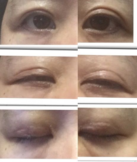 術後1年半の画像 二重全切開整形 注意 経過画像エグ グロです 眼瞼下垂 二重全切開眼瞼挙筋短縮