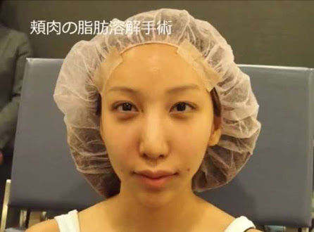 ざわちん整形願望告白も 勇気が