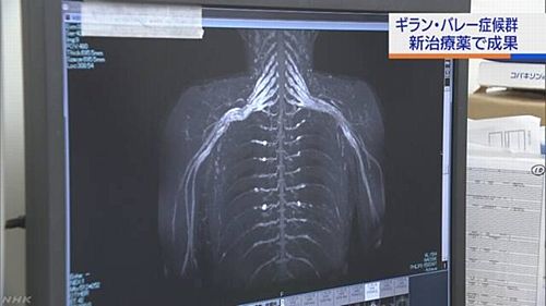【ギランバレー症候群】免疫抑制「エクリズマブ」投与 重症患者の70%余が回復=年間1400人が発症