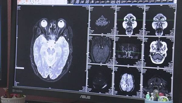 【千葉大附属病院】CT画像見落とし 腎臓がんと肺がんで2人死亡=会見で謝罪
