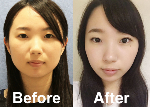 生活 美容 顔の脂肪吸引 術後でデカくなることってあるの いっちゃが 食べて痩せるブログ