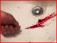 想像するだけでおぎゃあああ痛い(@_@;)親指の爪の下に溜まった血を針を刺して抜く(°_°)