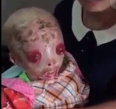 【閲覧注意】遺伝子異常で皮膚剥がれ落ちる病気（魚鱗癬）の少年