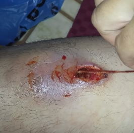 【閲覧注意】痛くないのかこれ。銃創に詰めていたガーゼを引き抜く映像がぐええええ(@_@;)