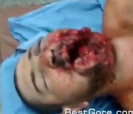 【閲覧注意】ショットガンで顔半分が吹き飛ばされている男性