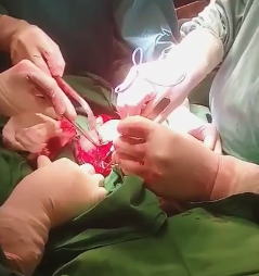 【閲覧注意】便秘の巨匠。ウンコが詰まり過ぎて手術で取り出してもらった動画。