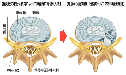 椎間板ヘルニア２