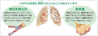 copd