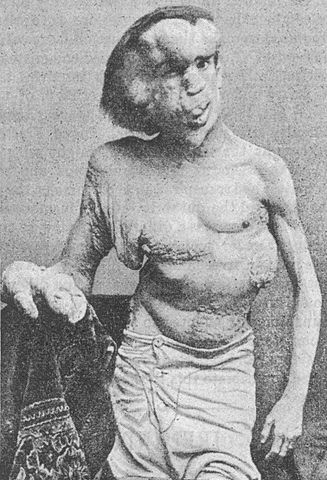 Josephmerrick1889