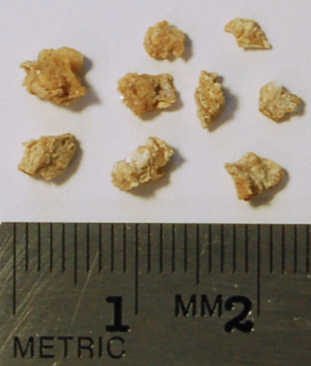 Kidney_stone_fragments