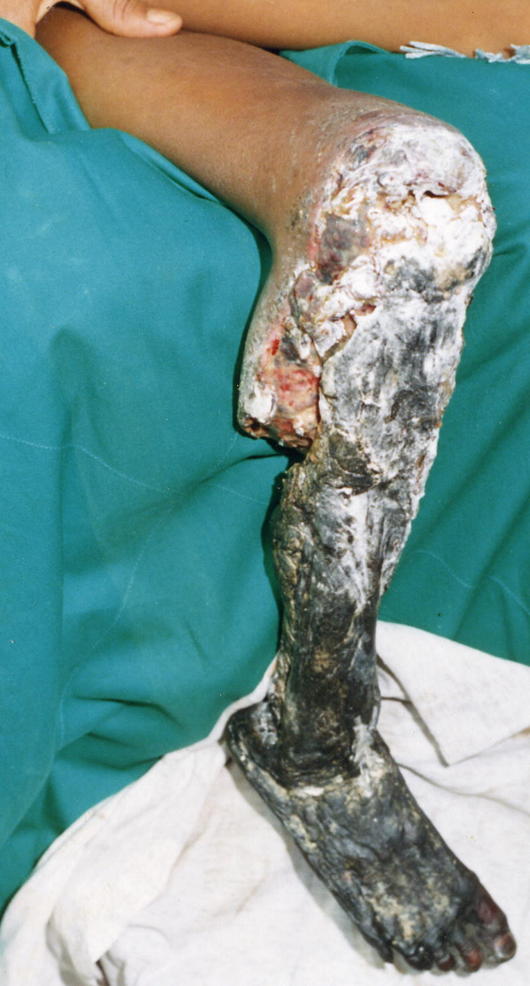 Tissue_necrosis_following_bite_from_Bothrops_asper_PLoS_Medicine