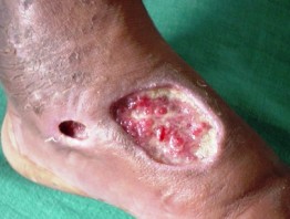 chronic-wound