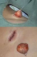 atheroma2