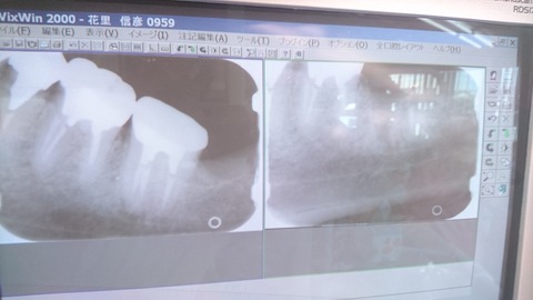 抜歯