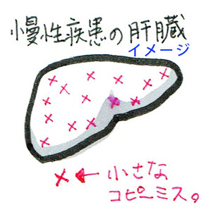 慢性疾患の肝臓イメ―ジ
