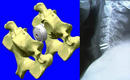 backborn_implant