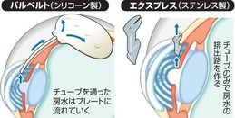 眼にもドレーン