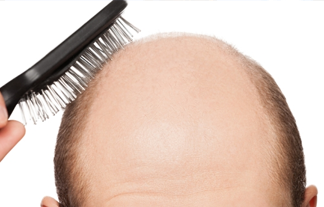 画像 : 頭皮が脂っぽい人要注意!薄毛や匂いのもとになるよう ...