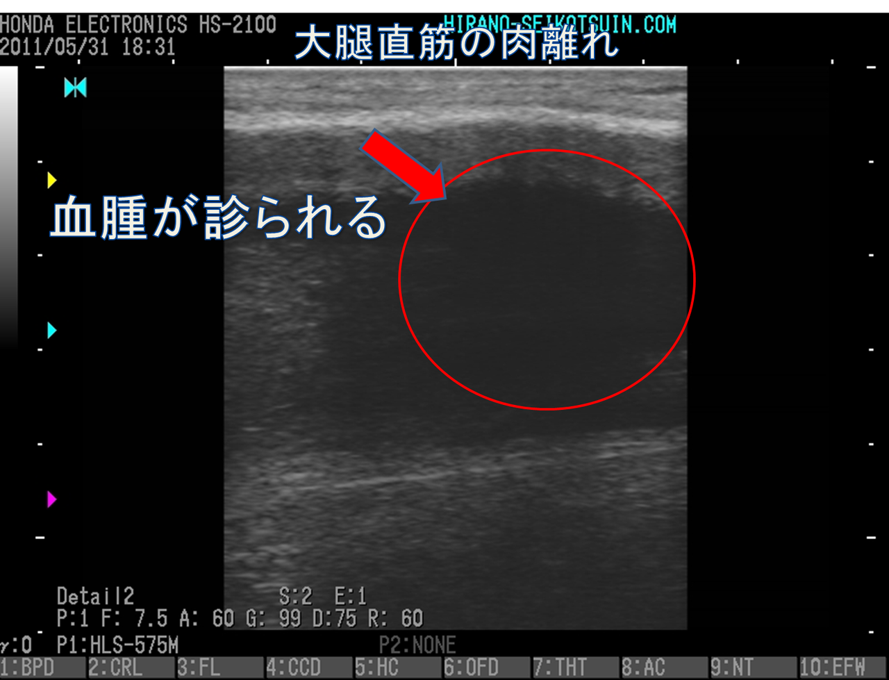 超音波診断 肉離れ