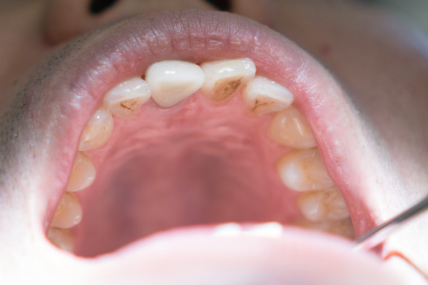 きれいな歯クリニックさくら 歯石除去-10