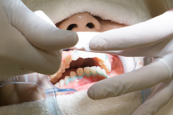 きれいな歯さくら ホワイトニング 4-3