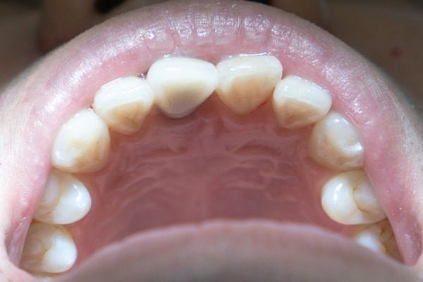 きれいな歯クリニックさくら 歯石除去-32