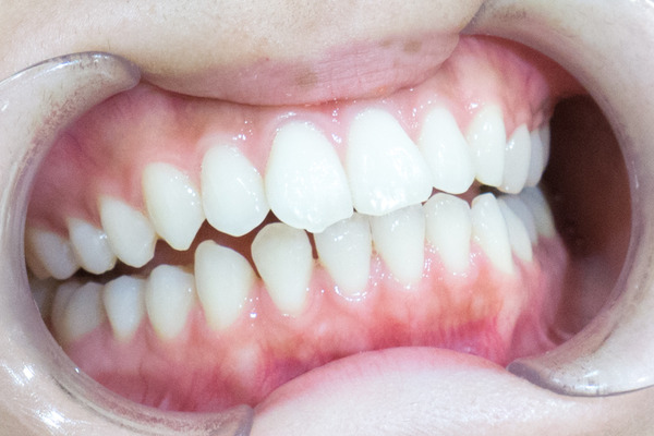 ホームホワイトニング後