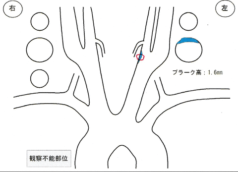 頸動脈