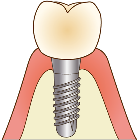 implant006