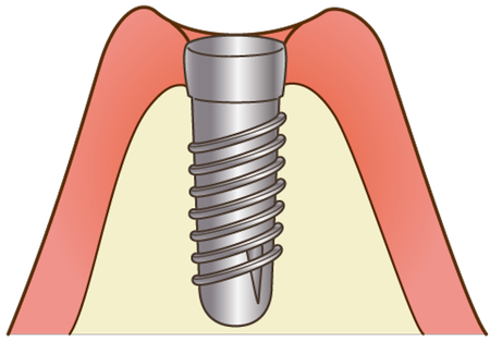 implant004