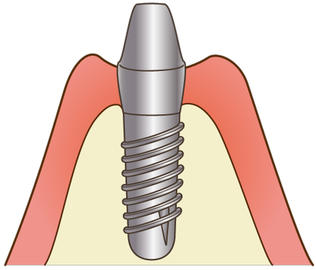 implant005