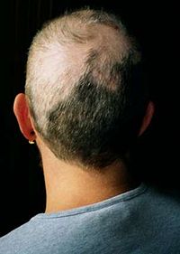 200px-Trichotillomania_1