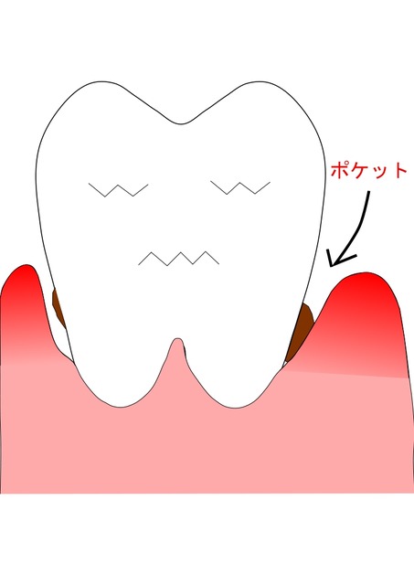 ポケットの歯　３