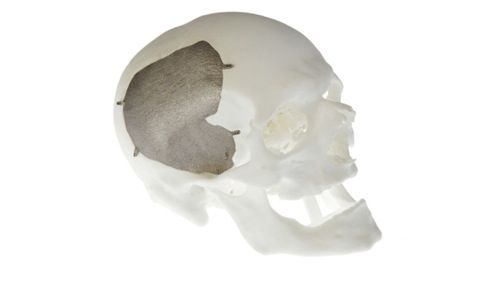 titanium-skull-implant.jpg Titanium skull implant