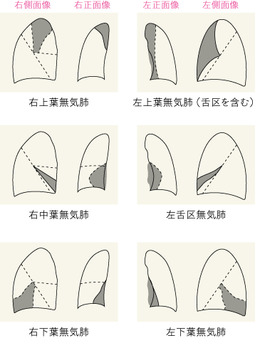 無気肺