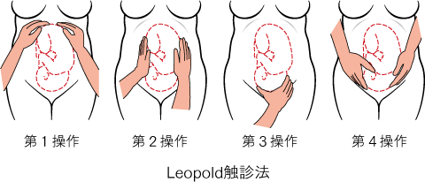 レオポルド触診