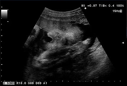 赤ちゃんの超音波画像