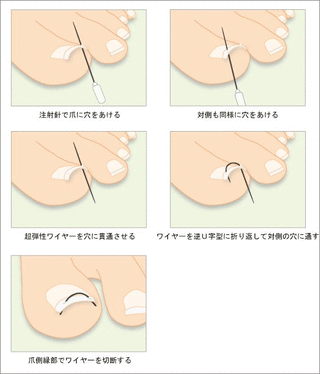 巻き爪3