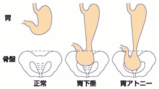 胃下垂