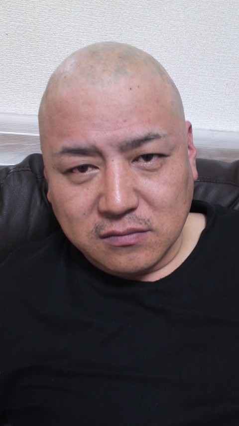 円形脱毛症ビフォーアフター Jin 自伝小説