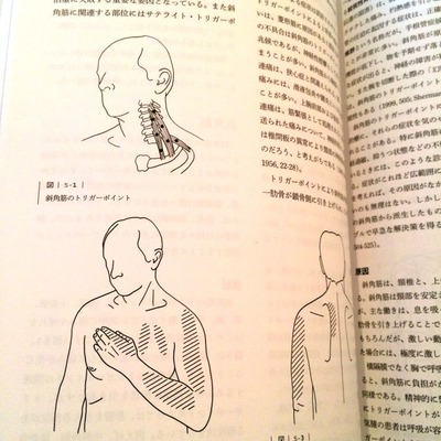 trigger point