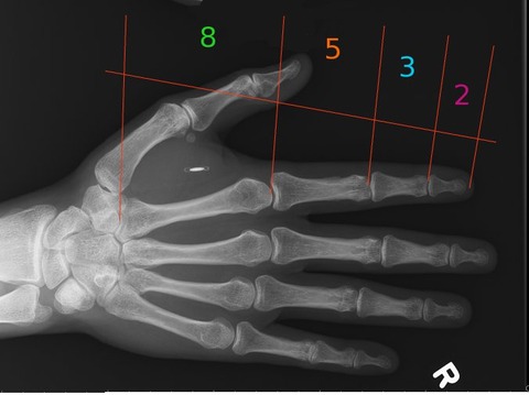 x-ray3