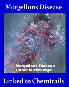 MorgellonsDiseaseChemtrails