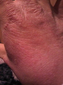 脱ステロイドで学んだ 角質培養という美容理論 手湿疹 脱ステロイド そして角質培養