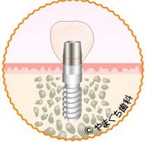 インプラント-2