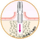 インプラント-1