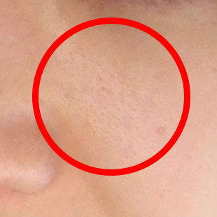 頬の毛穴 画像 頬の毛穴