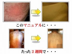 乾癬村上06