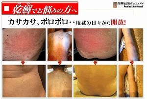 乾癬村上02
